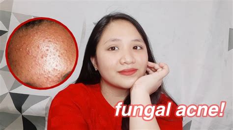 How To Treat Fungal Acne Philippines