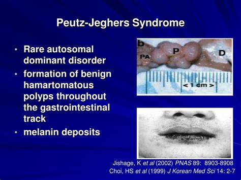 Ppt Peutz Jeghers Syndrome Lbk1stk11 Powerpoint Presentation Free