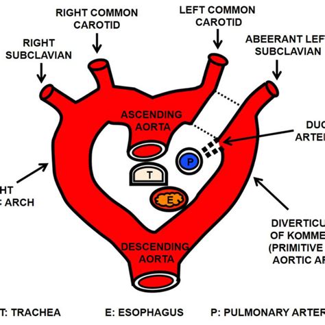 Diagram Explaining The Right Aortic Arch With Aberrant Left Subclavian