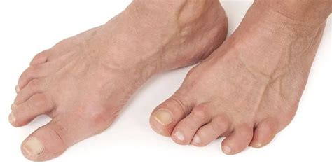 Signs And Symptoms Of Rheumatoid Arthritis Of The Feet Moreland Podiatry