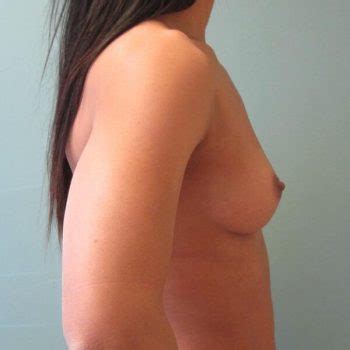 Brittney Atwood Nude Boob Job Photos Leaked Thotslife