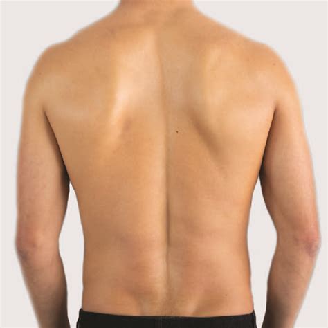 Full Back Shoulders Neck Results Laser Clinic