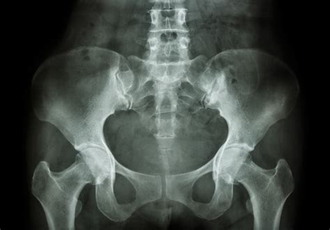 Film X Ray Of Pelvis Crush Back Pain