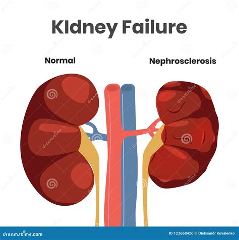 Vector Illustration Of The Kidney Failure Normal Kidney Versus Kidney