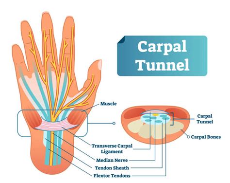 Carpal Tunnel Syndrome Stock Photos Pictures And Royalty Free Images