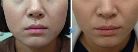 Botox Jaw Reduction With Botulinium Toxin A Doctor Isaac Wong