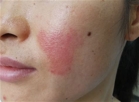 Acute Painful Rash On The Cheek Mdedge Dermatology