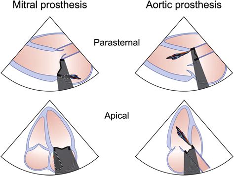 Recommendations For Evaluation Of Prosthetic Valves With