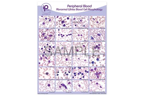 Hematology Abnormal White Blood Cell Morphology