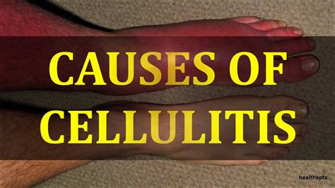Causes Of Cellulitis Youtube