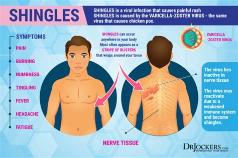 shingles symptoms risk factors and natural support strategies