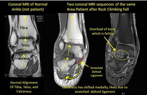 Foot Muscles Mri Anatomy Mri Of The Ankle Detailed Anatomy W