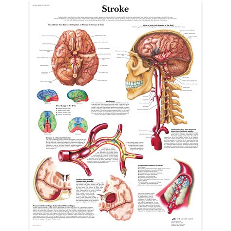 Definition of stroke (entry 2 of 3). Anatomical Charts - Neurological Posters - Pathology ...