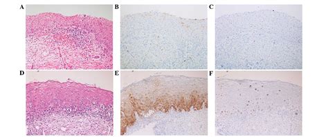 Efficacy Of P16 And Ki‑67 Immunostaining In The Detection Of Squamous
