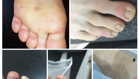 Researchers Discover New Coronavirus Symptoms Feet Lesions