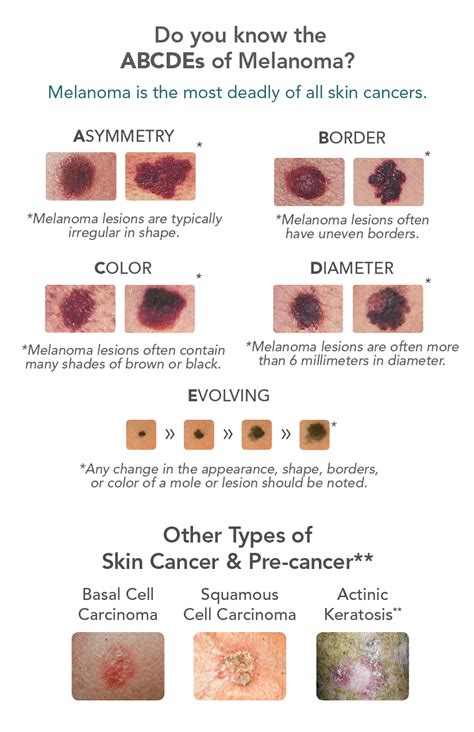 Skin Cancer Signs And Symptoms Idaman