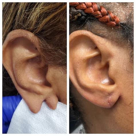 Otoplasty Jacksonville Ear Plastic Surgery Jacksonville Ear