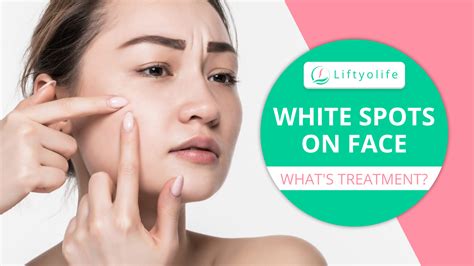 5 Causes Of White Spots On Face And Treatment