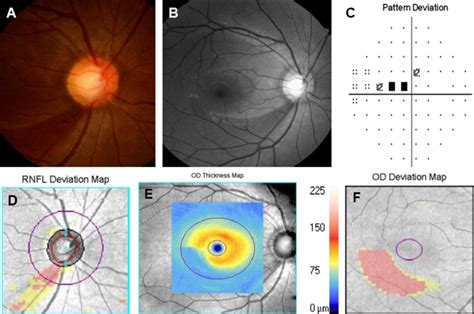macular imaging by optical coherence tomography in the diagnosis and management of glaucoma