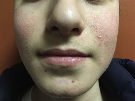 Parotid Swellings In An Adolescent The Journal Of The American Dental