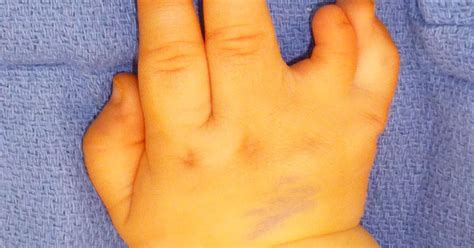 Ulnar Cleft Hand Part Ii Congenital Hand And Arm Differences