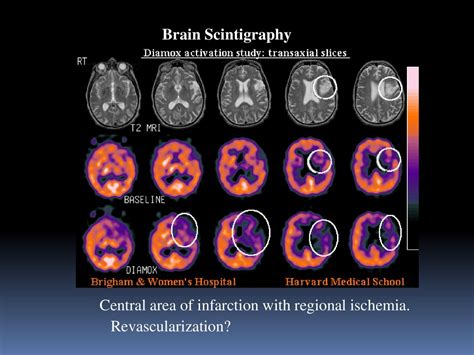Brain Scintigraphy Ppt Download