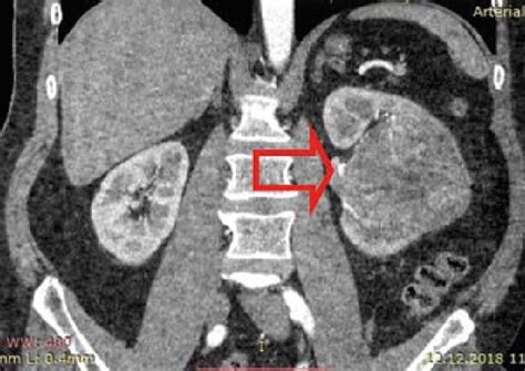 Ct Scan Of The Abdominal Cavity And Retroperitoneal Space Of Patient