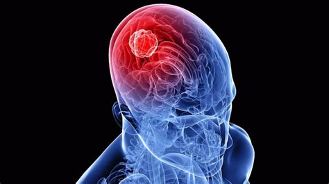 Brain Tumor Causes Symptoms And Treatment