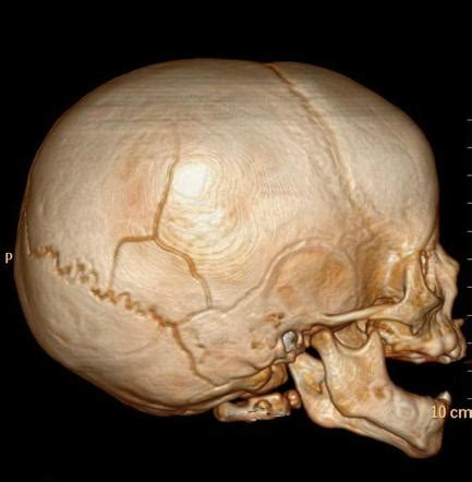 Skull Fractures Summary Radiology Reference Article Radiopaedia Org