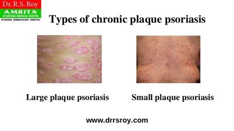 Plaque Psoriasis Treatment In Kochi Ayurvedic Skin Treatment In Ker