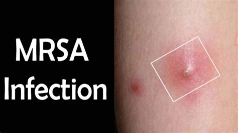 Mrsa Infection Symptoms Causes And Methods To Cure Mrsa Infection