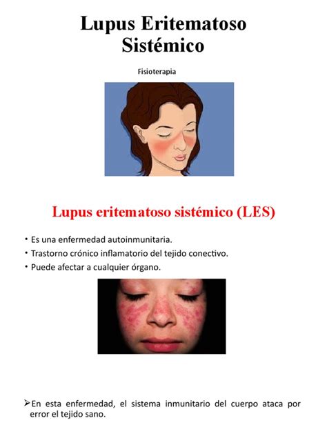 Lupus Eritematoso Sistémico 1 Pdf Lupus Eritematoso Sistémico