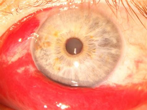Subconjunctival Haemorrhage Kindsight Eye Specialists