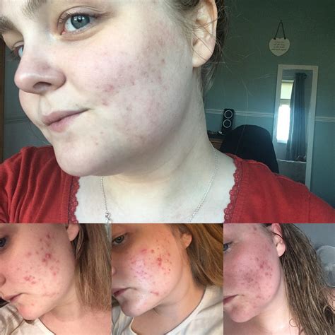 Acne People With Acne Scars What Have You Found That Helps After Battling With Cystic Acne