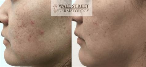 Acne Scar Subcision Nyc Wall Street Dermatology