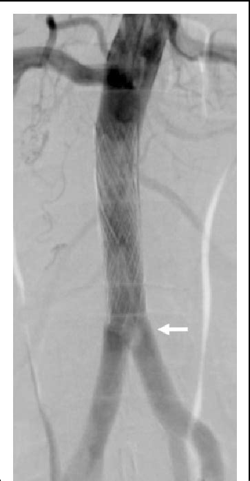 Direct Stenting Using Bare Metal Balloon Expandable Stents On A