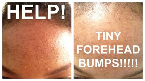 How To Get Rid Of Tiny Forehead Bumps Forehead Acne Tiny Forehead