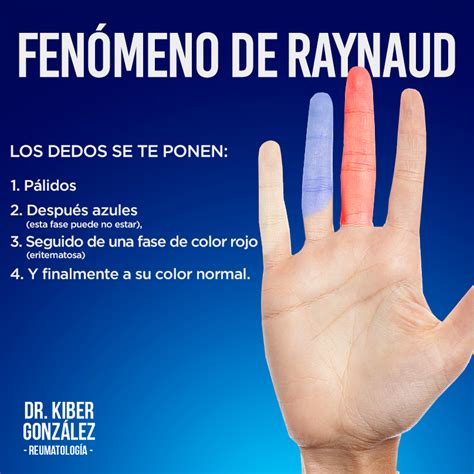 ¿sabes Qué Es El Fenómeno De Raynaud Reumatólogo En Monterrey Dr