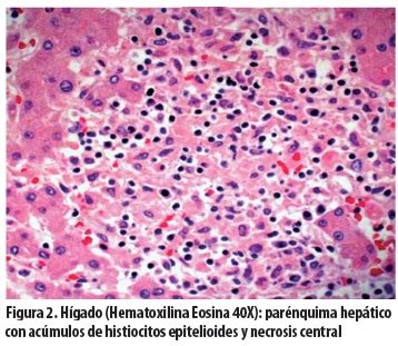 Hypotonia, dystonia, dysuria, lymphorrhoea, cystotomia, spondylodynia, myelopathia, myalgia, histologia, cystodynia, hemialgia, myelomalacia, spondylectomia, adenomalacia, cystectomia. Conferencia clínico patológica (CPC): insuficiencia ...