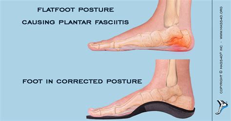 How Flatfoot Posture Cause Plantar Fasciitis Mass4d® Foot Orthotics