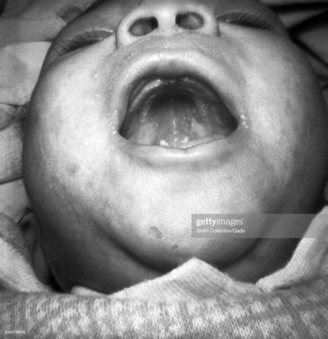 A Photograph Of A Young Child With Congenital Syphilis Exhibiting