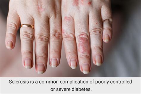 6 Skin Problems Associated With Diabetes Igood Health Blog