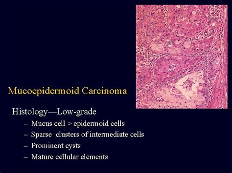 Salivary Gland Neoplasms Mucoepidermoid Carcinoma Most Common Salivary