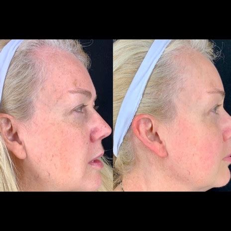 BBL Photofacial Before And After Revee Aesthetics