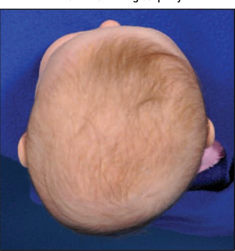 Figure 3 From Deformational Plagiocephaly A Review Semantic Scholar