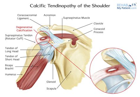 Calcific Tendinopathy Of The Shoulder Rehab My Patient