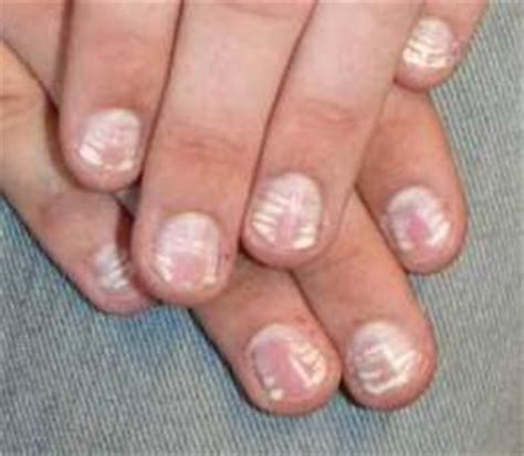 The new england journal of medicine: Leuconiquia - EcuRed