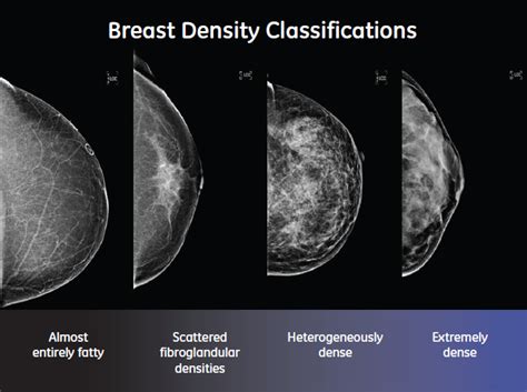 You can help reduce your risk of cancer by making healthy choices like eating right, staying active and not smoking. Dense Breast Tissue - Cedar Rapids, IA - Mercy Medical Center
