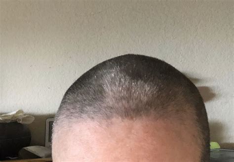 Shaved My Wifes Head Yesterday Due To Chemo Causing It Fall Out Rapidly