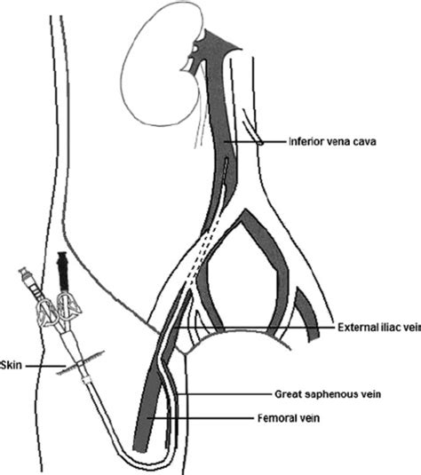 Positioning Of Central Venous Catheter Into The Great Saphenous Vein